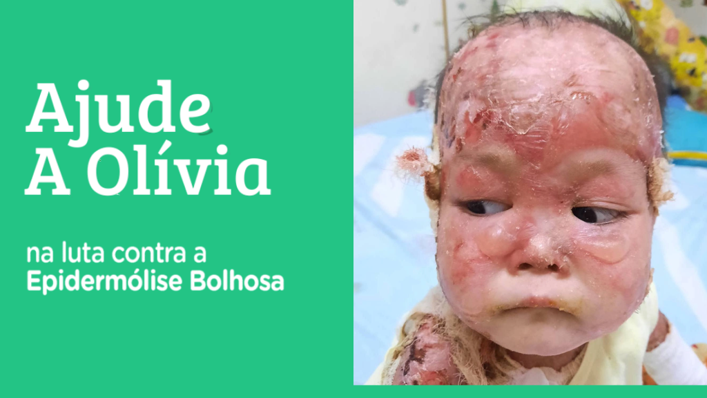 Ajude a Olívia na luta contra a Epidermólise Bolhosa