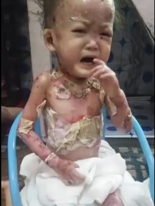 Olívia com curativos pelo corpo durante os cuidados diários